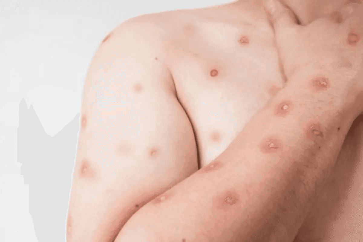 Sobe para 140 o número de casos confirmados de Mpox no país